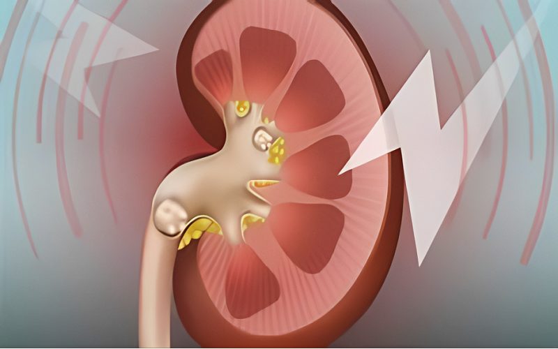lowers-the-risk-of-kidney-stones